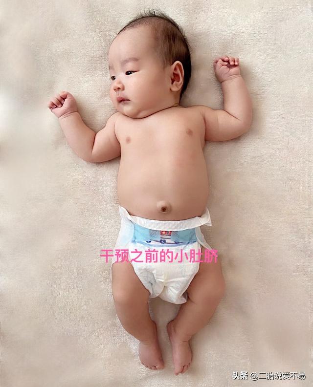 新生儿脐疝，妈妈用简单方法20天治愈