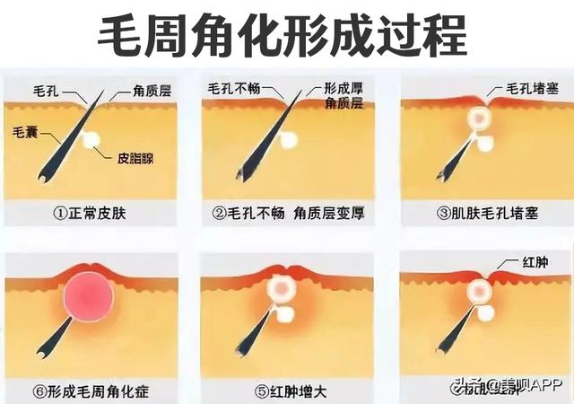 有毛周角化症怎么治