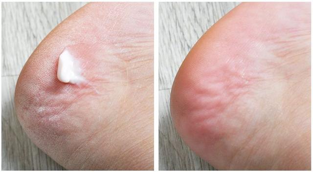 手背皮肤就长鸡皮一样