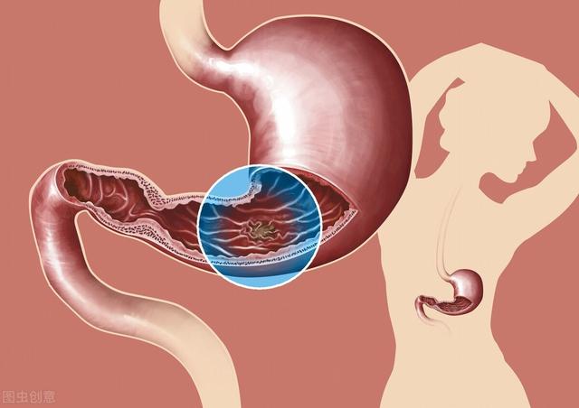 得了胃溃疡只能长期用药吗？坚持做到治疗护理6步走，好得快