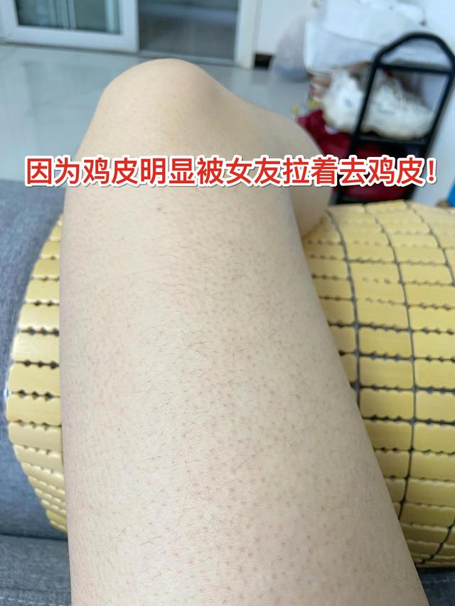 男友会接受女友有鸡皮肤吗