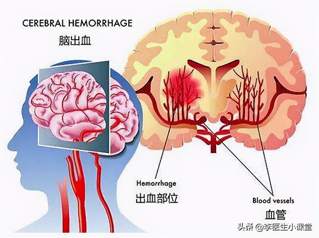 家人突发脑出血咋办 医生教你几个家庭急救办法 关键时候能救命 全网搜