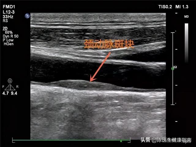 动脉硬化≠动脉粥样硬化，学好软化血管的3步骤，血流通畅少堵塞