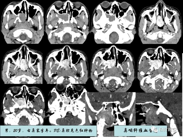 鼻咽鳞状上皮增生伴不全角化