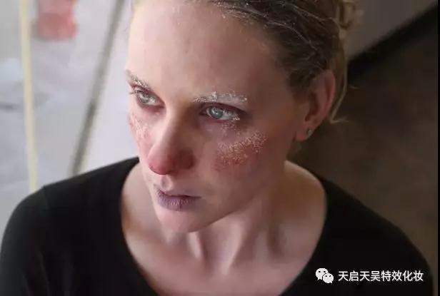 冻伤怎么做 冻伤怎么做（冻伤怎么处理） 生活