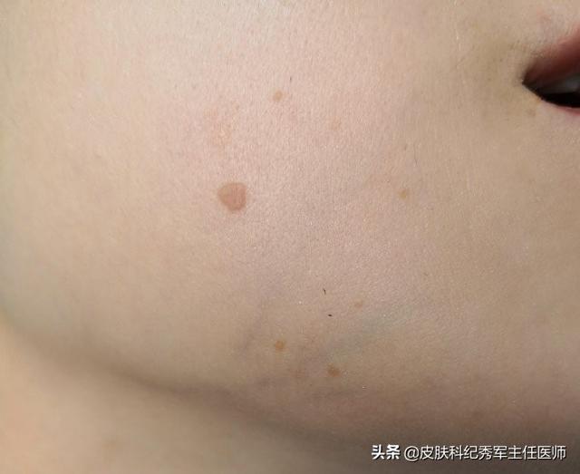 脂溢性角化和扁平疣判断