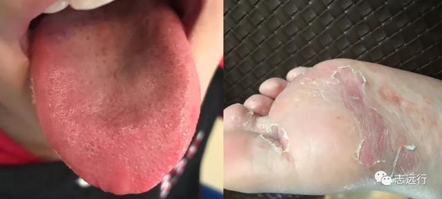 角化形手癣中药熏洗方