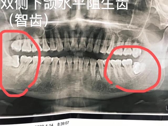 「备孕期」牙病患者需要注意这些