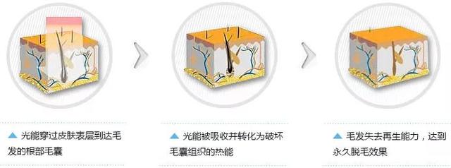 怎么样可以永久脱毛