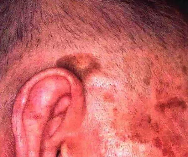 皮肤指异性角化