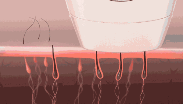 毛囊炎毛周角化知乎