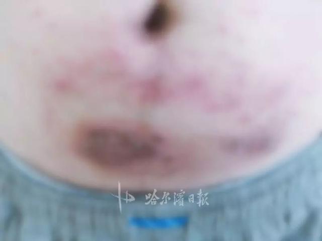 鸡皮肤扣的流脓了