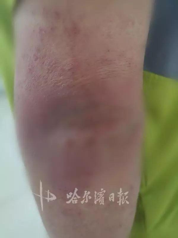 鸡皮肤扣的流脓了