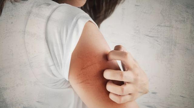 皮肤角化脱皮消银颗粒