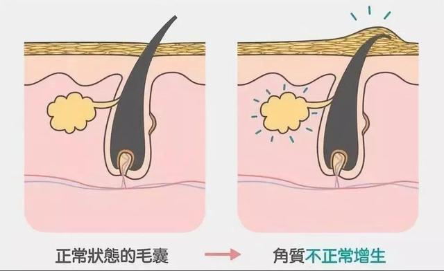 脖子皮肤粗糙像鸡皮瘙痒