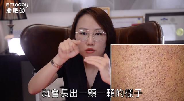 毛周角化症多久可以改善