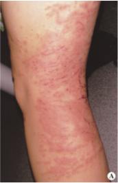 谍影对称性红斑角化症