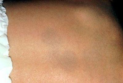 小孩脸部毛周角化图片