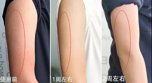 鸡皮疙瘩抓破后红肿