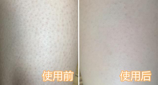 鸡皮疙瘩抓破后红肿