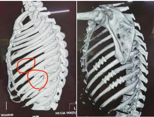 肋骨断了怎么办