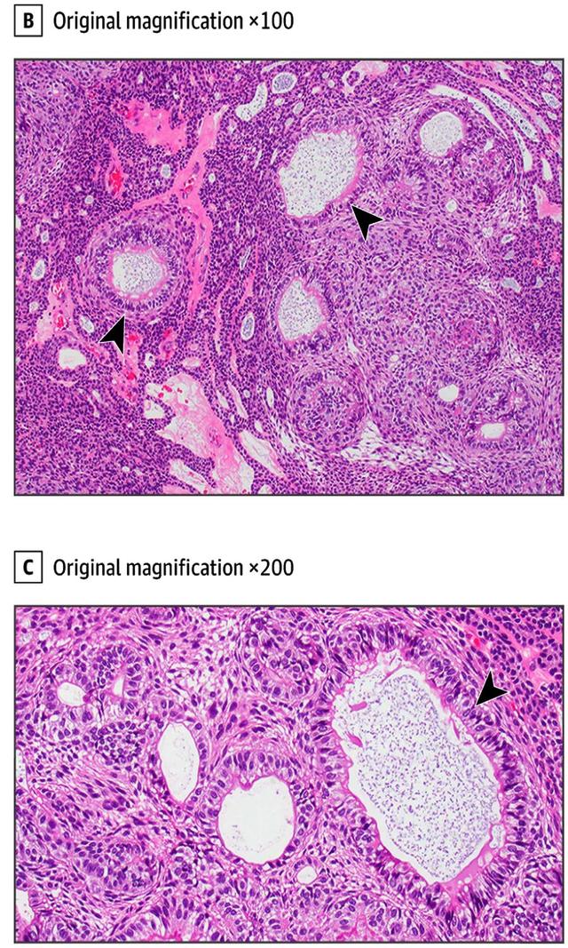 牙源性角化囊肿属于面裂囊肿