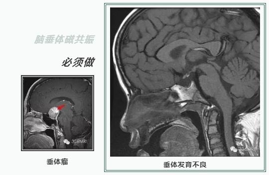 我家宝宝不长个怎么办？这几类检查了解一下