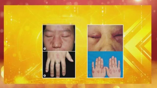 对称红斑角化症为什么发红