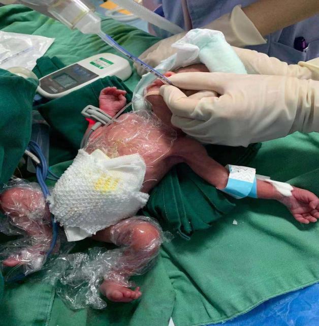 体重最低时仅910克！崇州“巴掌宝宝”闯关75天后，如今快5斤啦