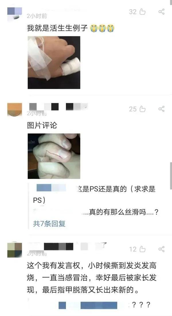 手上倒刺一直撕一直长，到底孩子缺了哪种维生素？