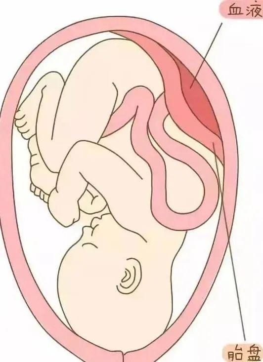 二胎妈妈突发胎盘早剥，多学科展开生死营救