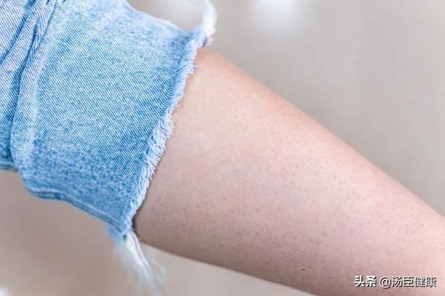 红色红点摸起来有点像鸡皮疙瘩