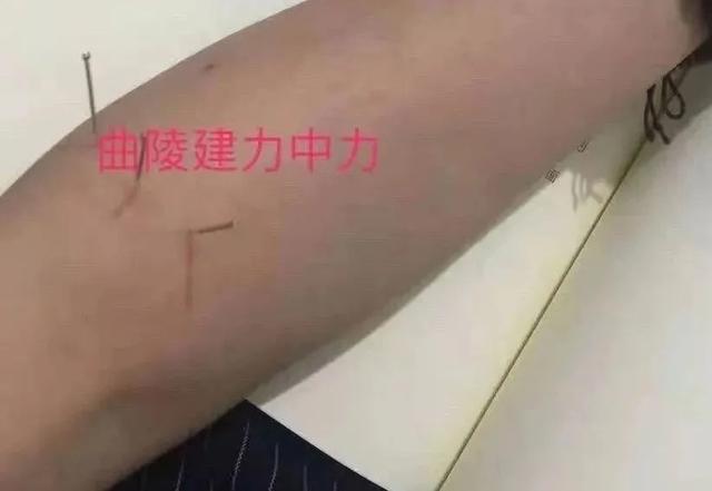 中医针灸鼻腔疾病处方1