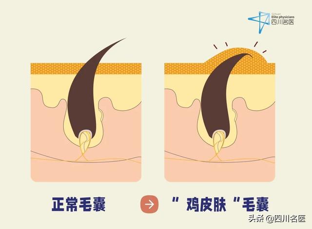 脸毛周角化