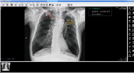 天医云智慧医疗再发力，人工智能精准赋能医学影像
