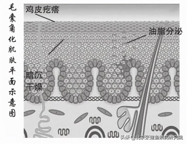 毛周角化症会自愈么
