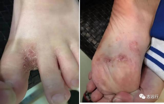 角化形手癣中药熏洗方
