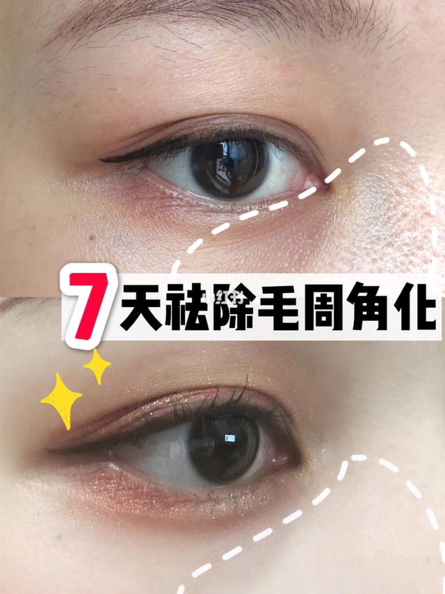 毛质角化症多大可以消除