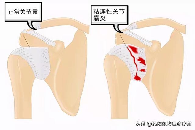 肩膀痛怎么办