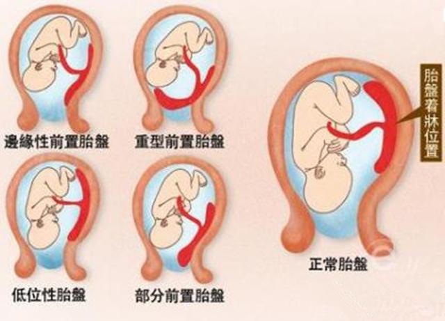 检查副胎盘什么意思