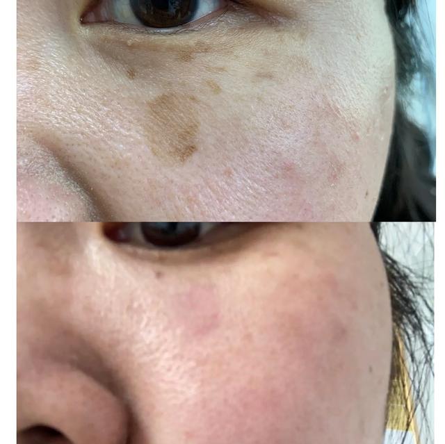 汗孔角化症会越长越多吗
