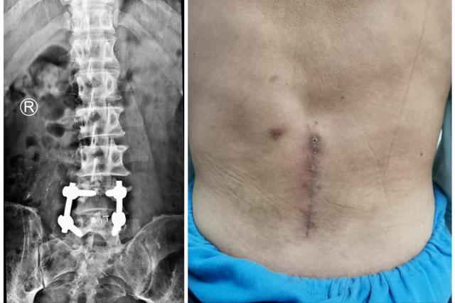 中老年人腰间盘突出，前中期预防和治疗很关键，后期多是手术