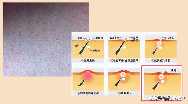 有毛周角化症怎么治