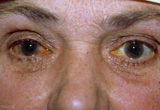 老年人常见的眼病哪些除了老花眼还有4种老年高发眼病要小心