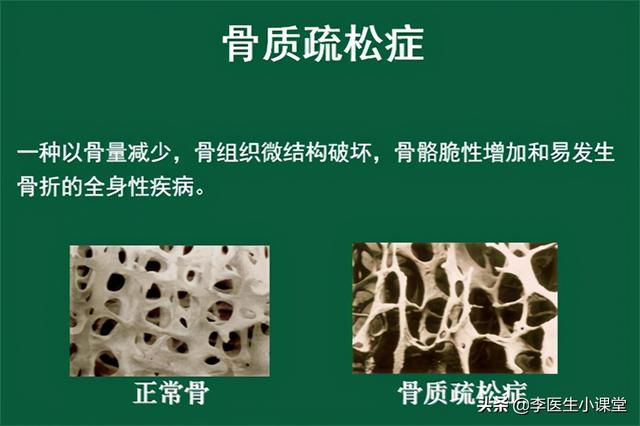 五十岁的女性，如何补钙对抗骨质疏松？这3个细节要注意