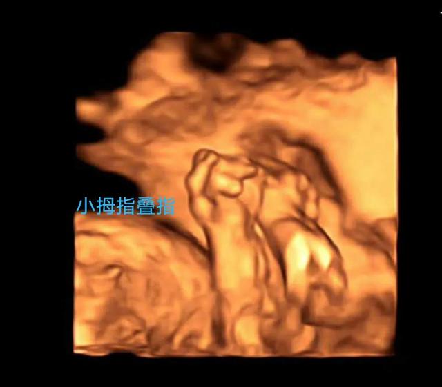 你也能看懂的胎儿畸形——病例分享