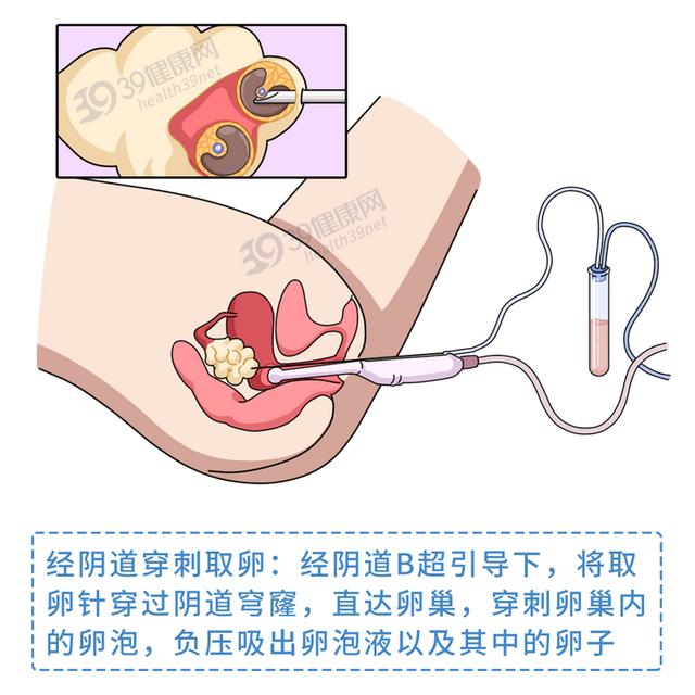 做试管婴儿有多“遭罪”？一篇漫画解释整个过程，看完泪目了