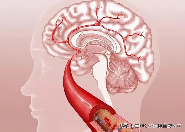 冬季来临 患有心血管疾病中老年人 在晨起的时候 需要注意哪些事项？