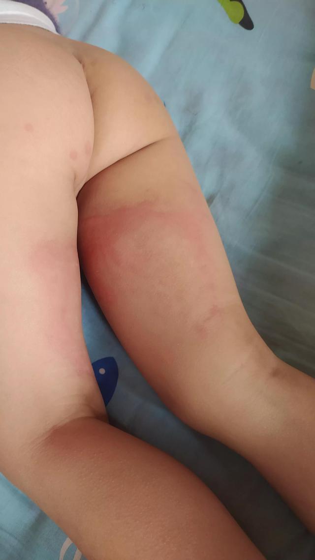 普通药物也会过敏，过敏体质小孩子要注意，