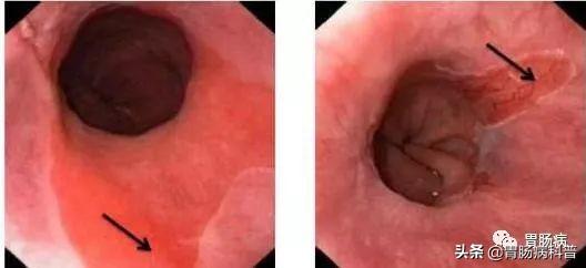 食道癌部分角化